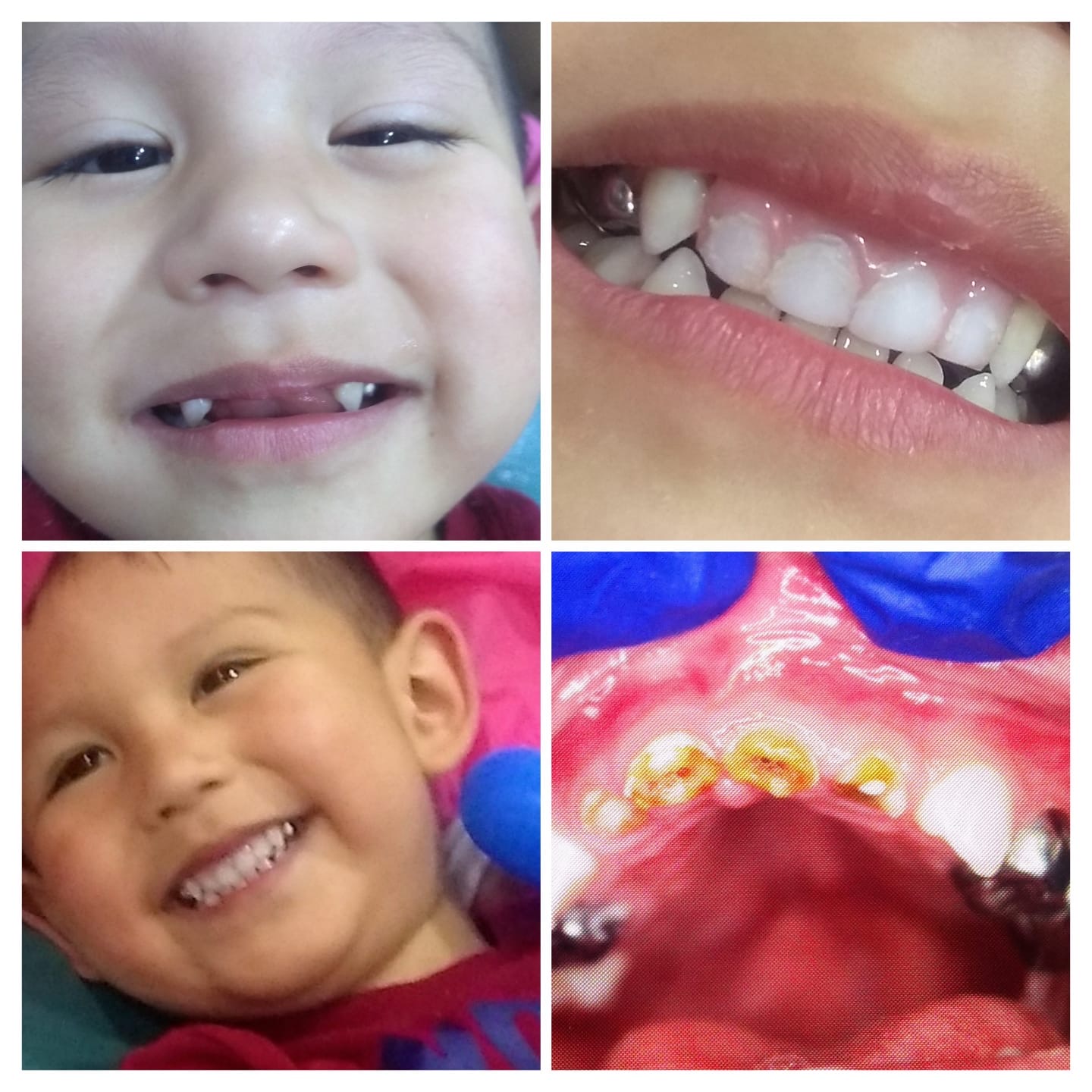 Antes y después de tratamiento